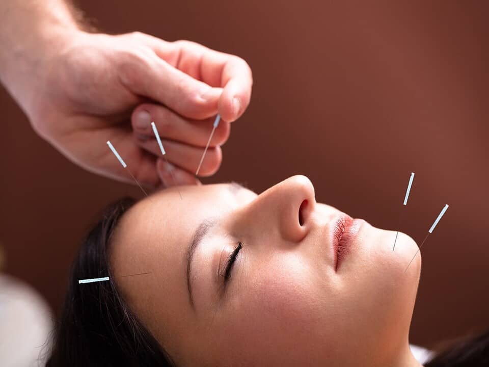 Acupuncture-For-Migraines-And-Headaches
