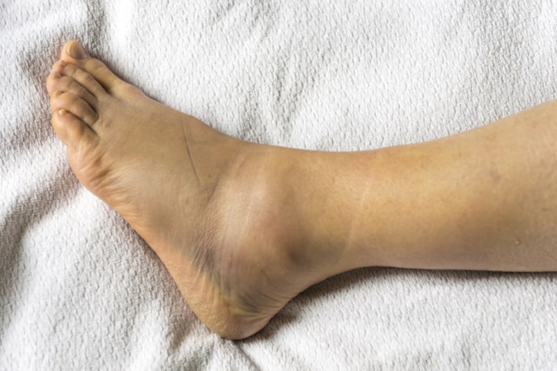 Ankle-sprain-with-physiotherapy
