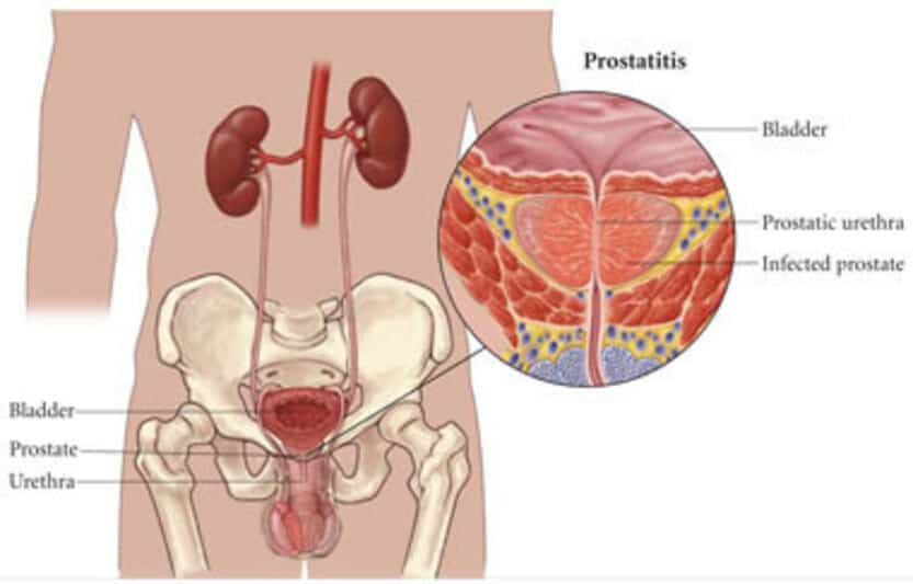 Chronic Pelvic Pain Syndrome