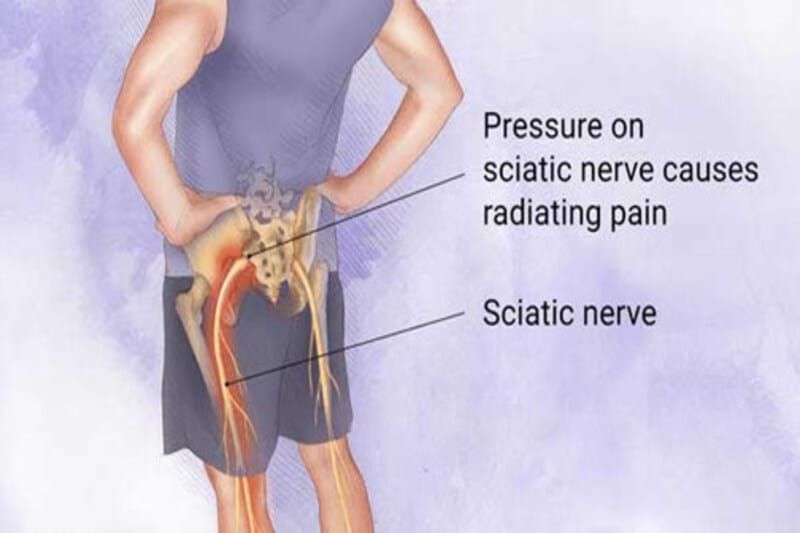 Sciatica-with-physiotherapy