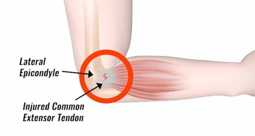 Lateral Epicondyle