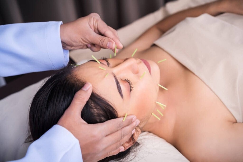 Acupuncture Treatment Headaches Migraines