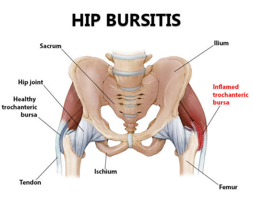 Hip bursitis treatment at physiotherapy clinic in Burlington, Ontario