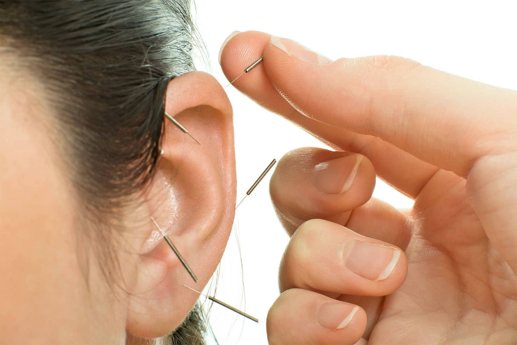 Acupuncture for Anxiety