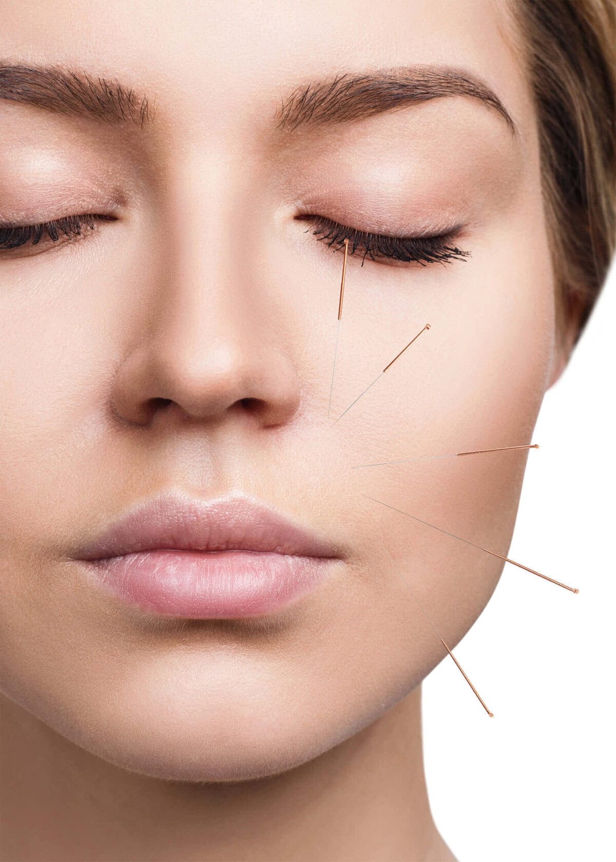 Acupuncture for fertility