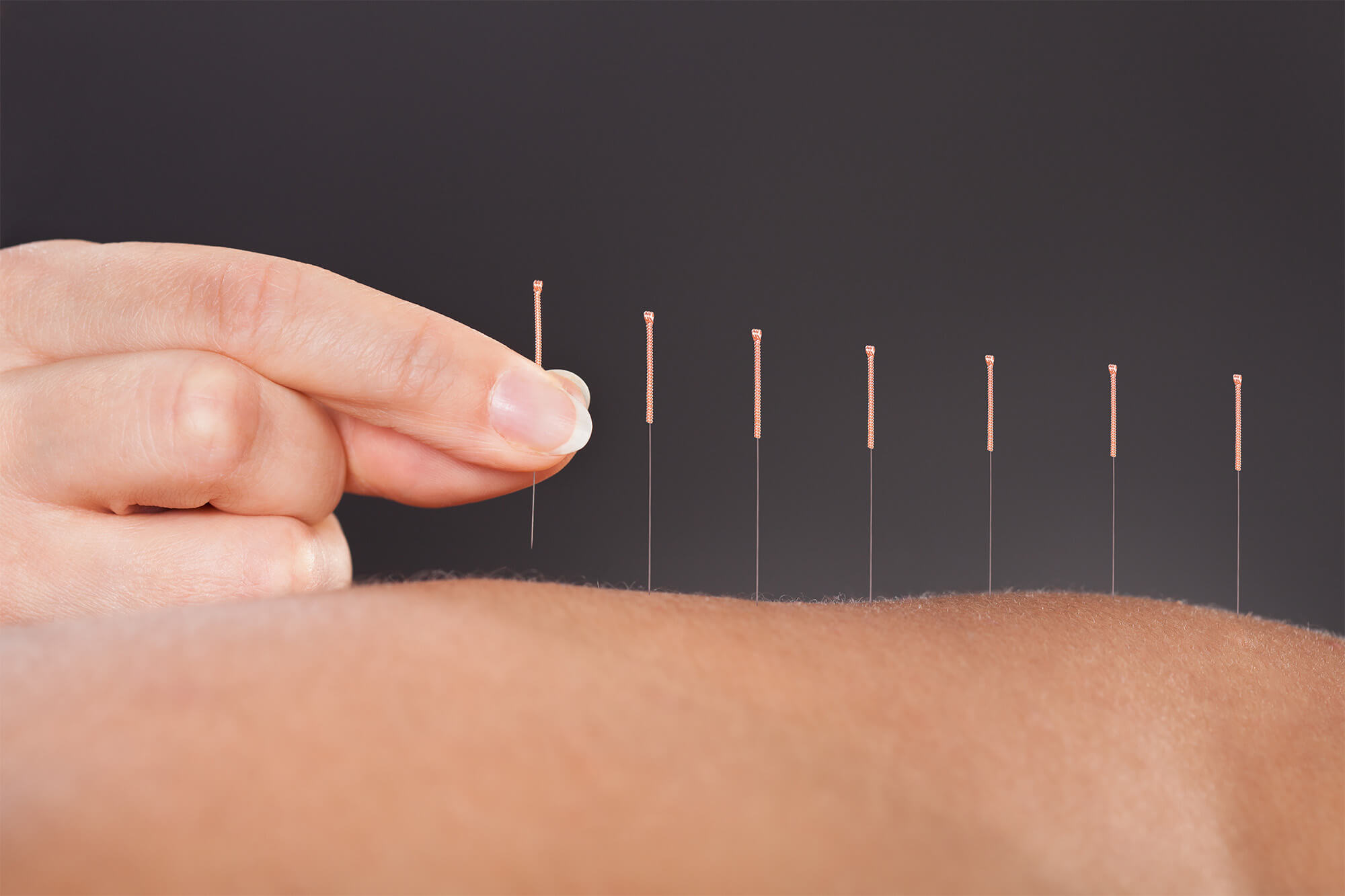 Acupuncture for stress detox