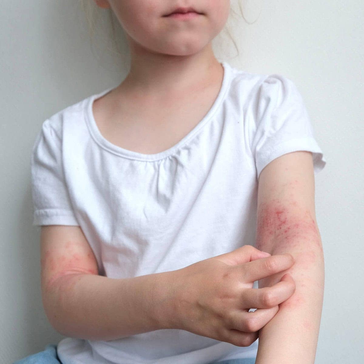 Child receiving naturopathic treatment for eczema at clinic