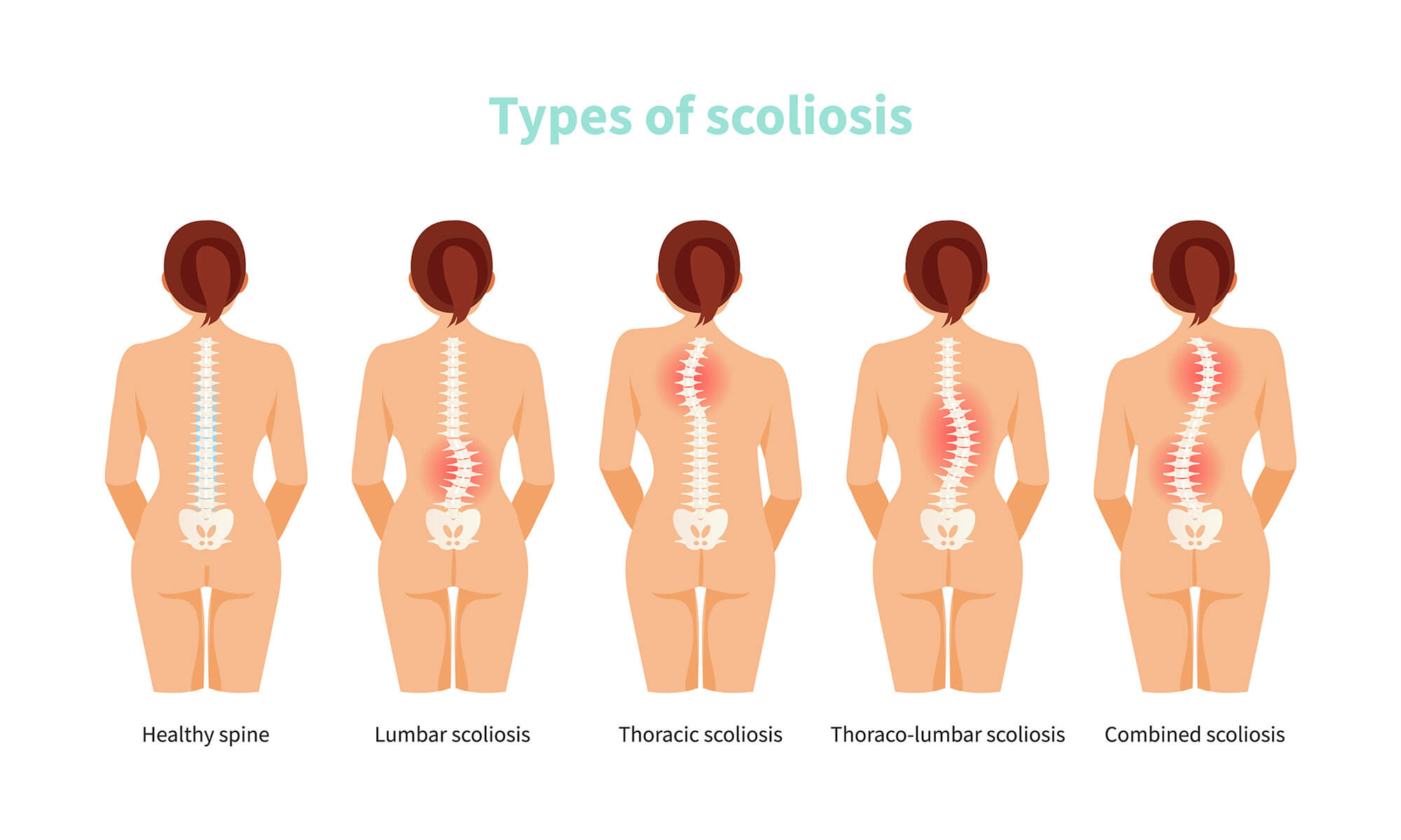 Diagram illustrating different scoliosis types for treatment insights