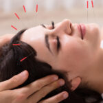 cosmetic acupuncture