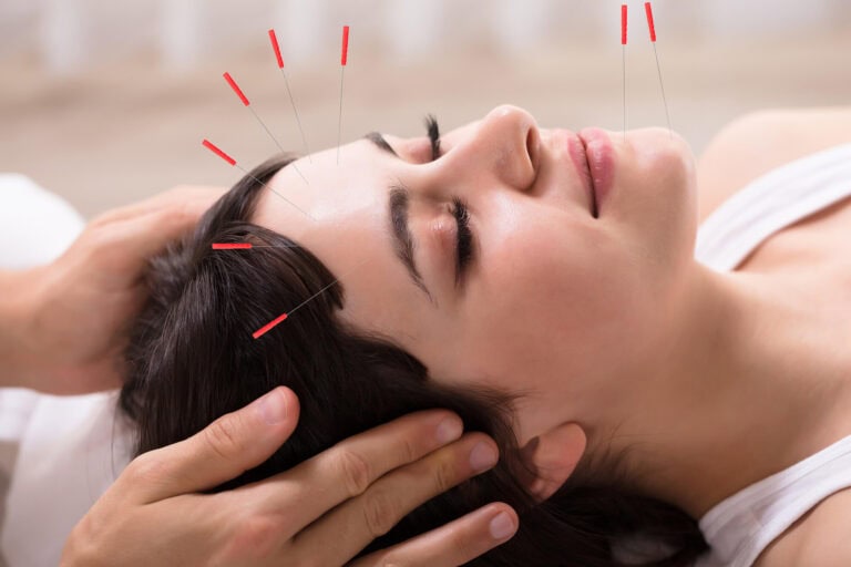 cosmetic acupuncture