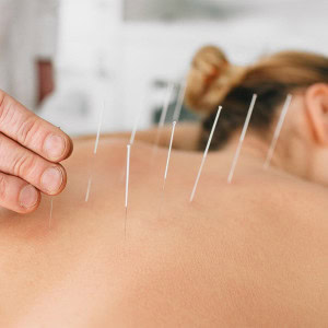 acupuncture for anxiety cropped