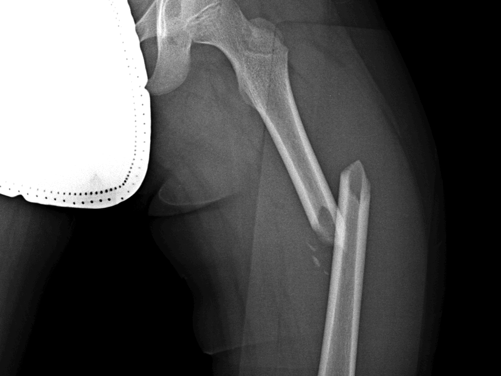 Femur Fracture