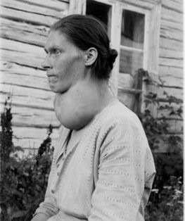 A black and white photo of a woman with a very swollen neck