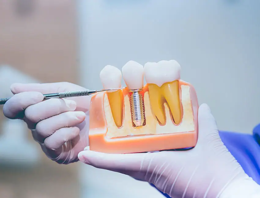 getting dental implants