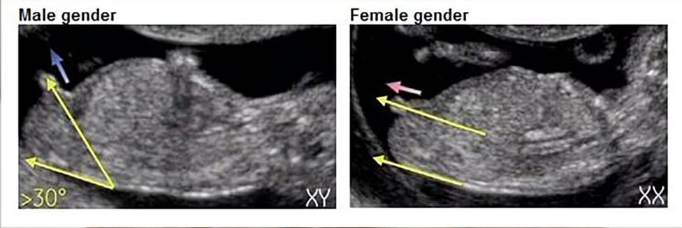 how to tell the gender of your baby