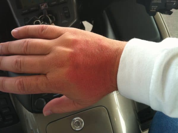 Sunburn Sunburn