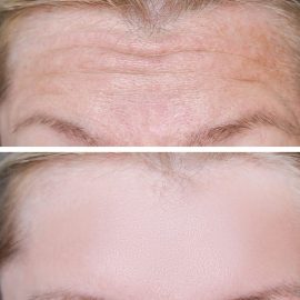 Botox before and after forehead