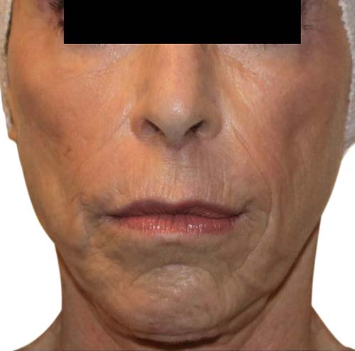 wrinkle reduction 1 after