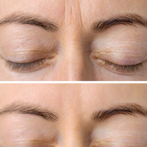 Botox before and after Facial