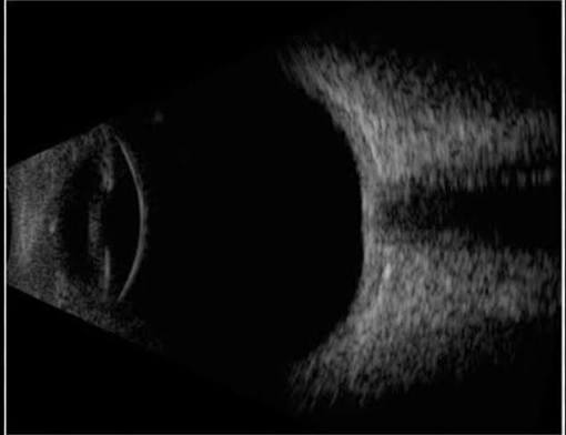Augen-Ultraschall zur Beurteilung der Netzhaut bei dichter Glaskörperblutung