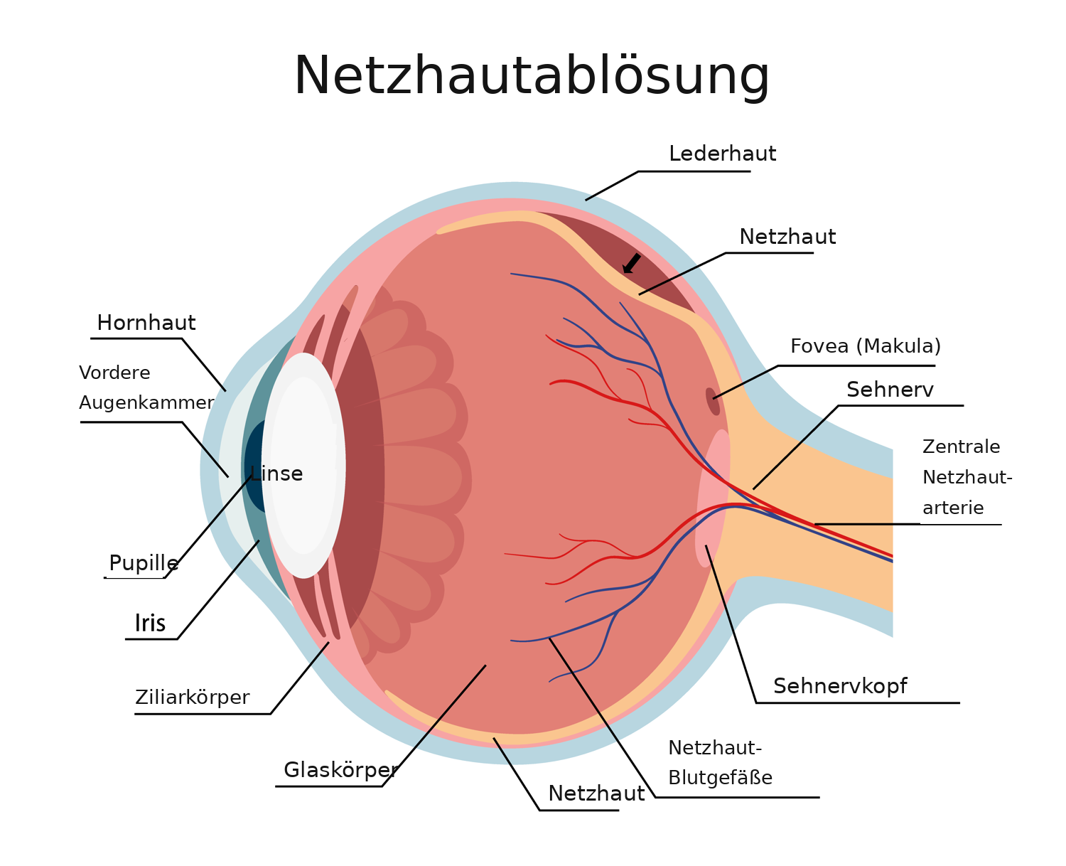 Beschriftetes Schema: Augenquerschnitt mit abgelöster Netzhaut (Ablatio retinae)