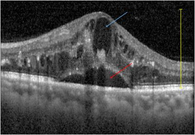 OCT-Aufnahme der Makula mit Flüssigkeitseinlagerung bei diabetischem Makulaödem