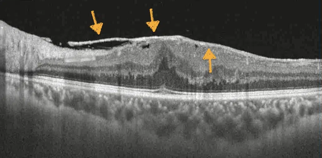 OCT-Schichtaufnahme der Makula mit epiretinaler Gliose und Netzhautfältelung