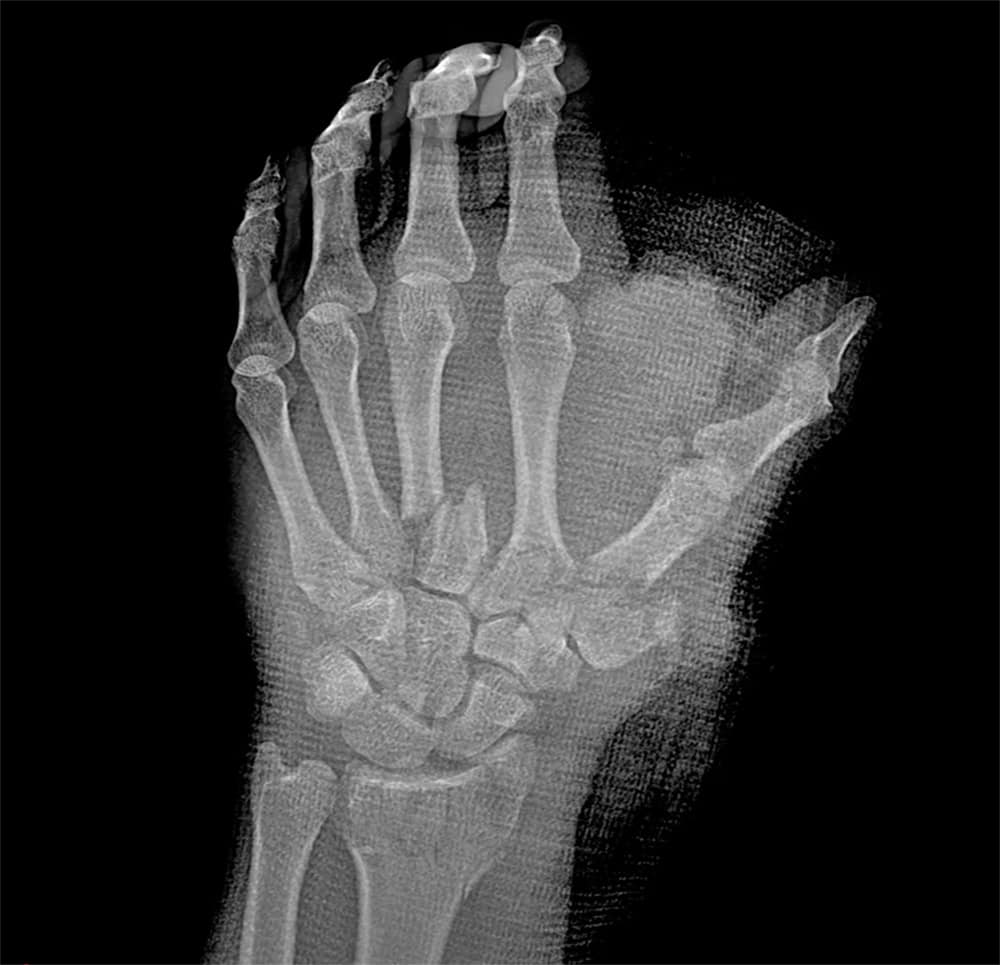 x-ray of a hand showing broken bones.