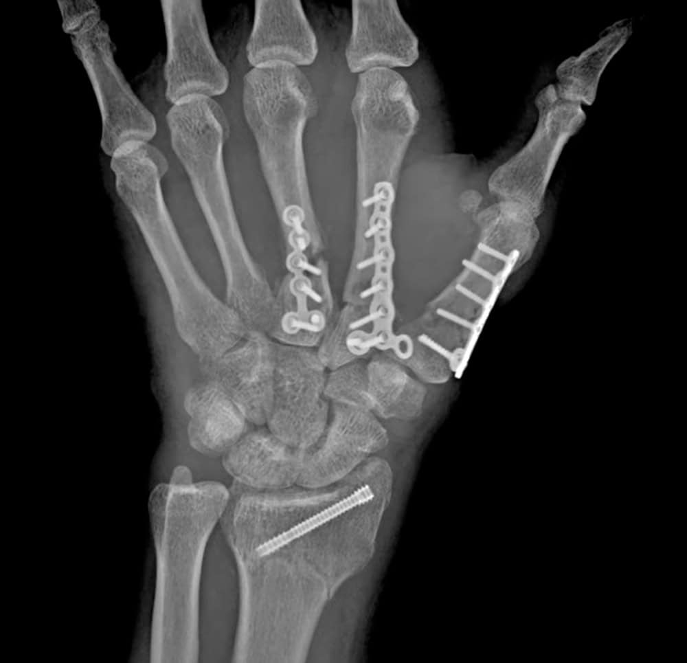 An x-ray of a hand showing where pins were inserted.