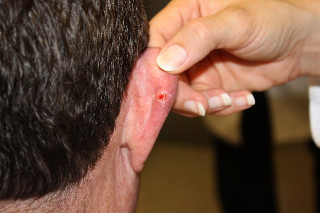 A photo of a mans ear with basal cell carcinoma