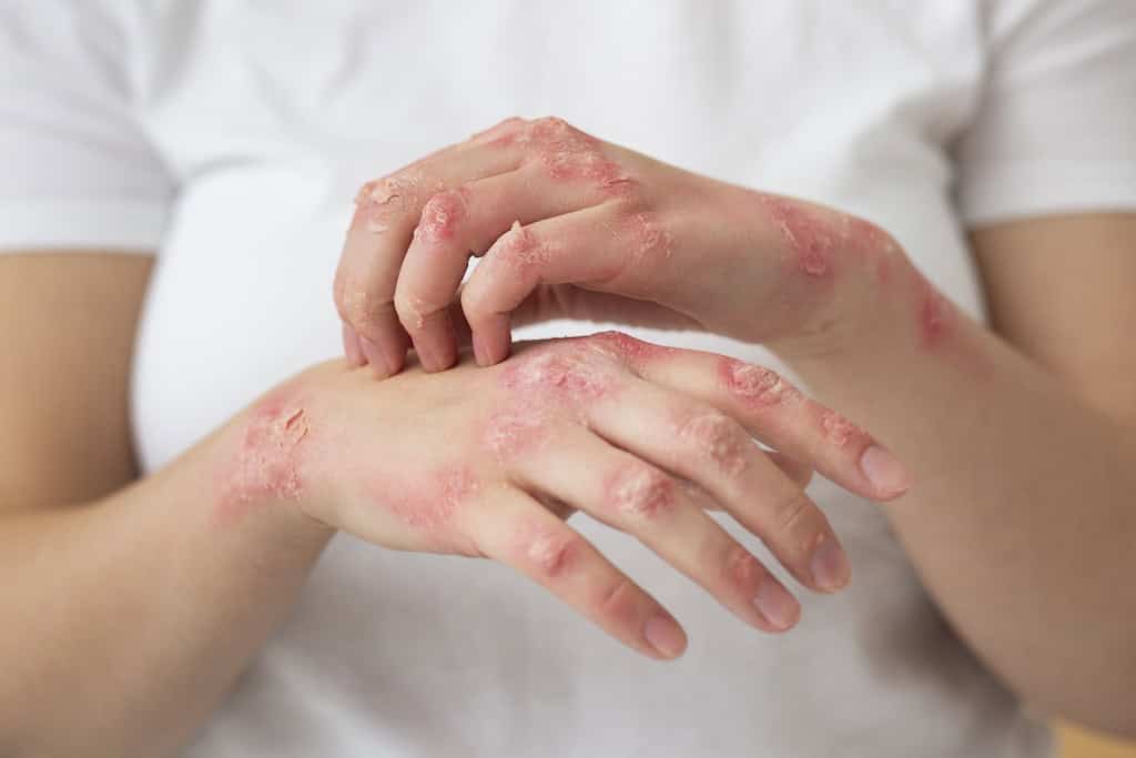 Protect Your Skin Year-Round