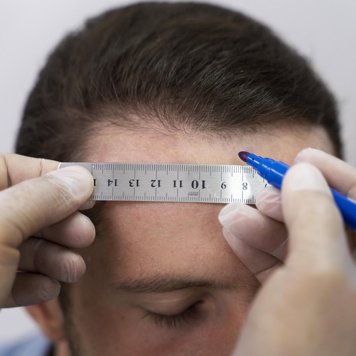 Turkey Leads in Affordable Hair Transplants.