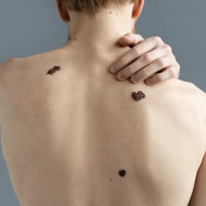 Laser Mole Removal Can Transform Your Skin.