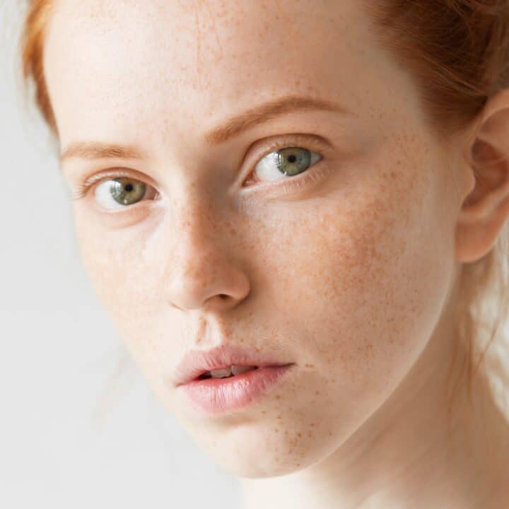 Options for Treating Melasma and Age Spots.