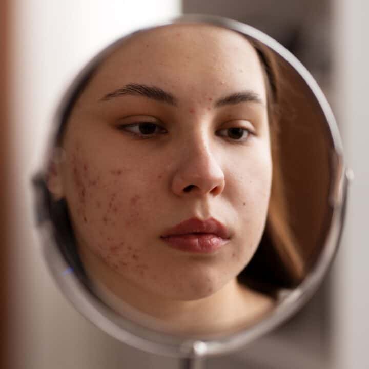 Role of Acne Clinics in Enhancing Beauty.