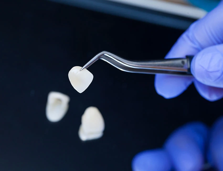 veneers vs. dental crowns