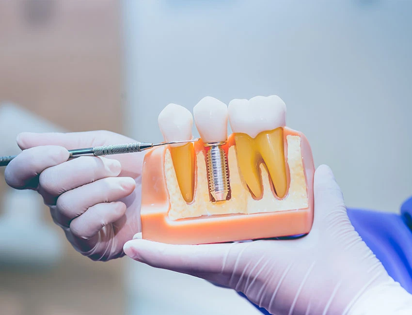 dental implants and gum disease