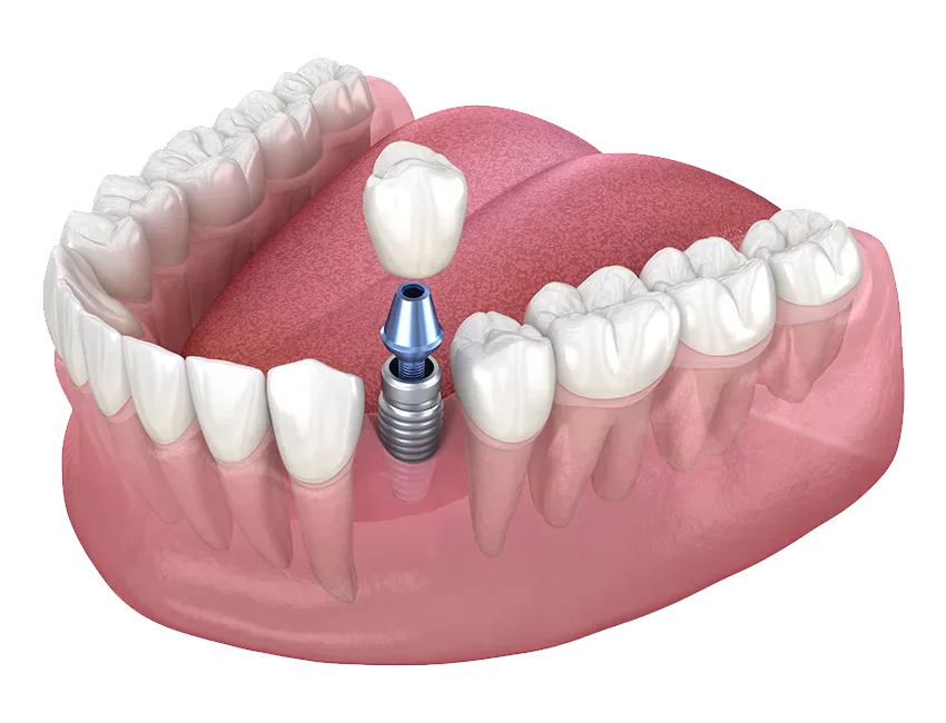 dental implants vs. partial dentures