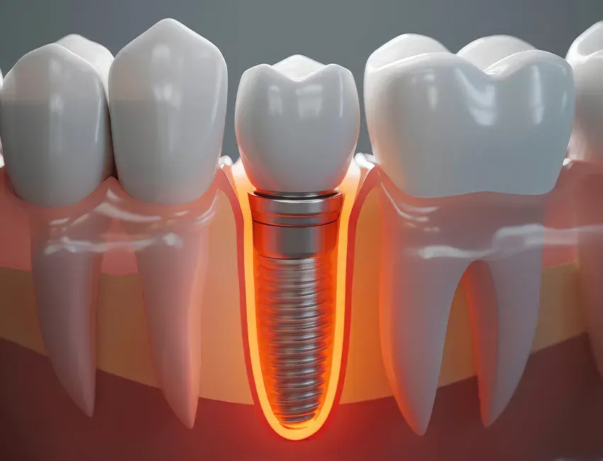 dental implants