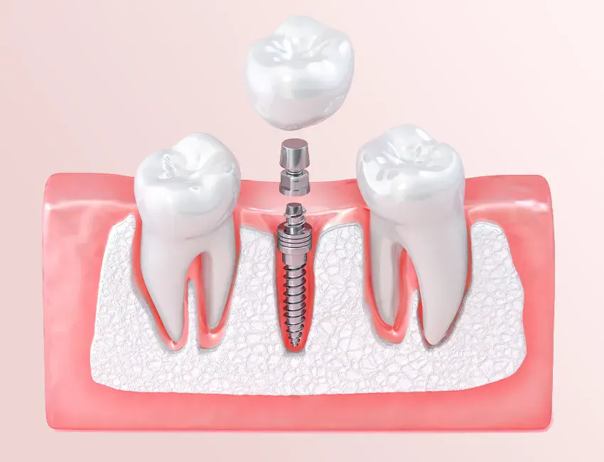dental implants