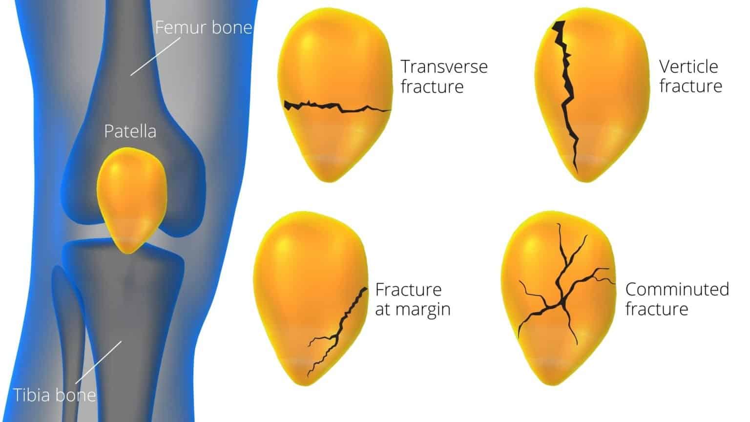 Kneecap Fracture _ 9 Easy Patella Fracture Rehabilitation Exercise ...