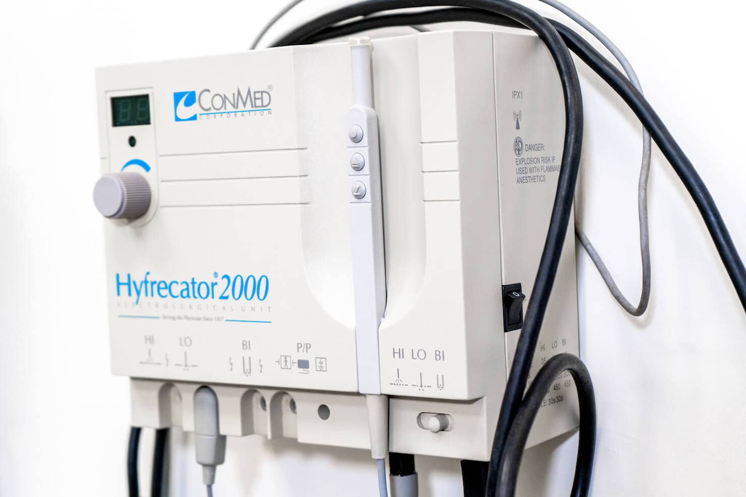 Is Hyfrecator Safe? , Hyfrecator Treatments – WYLC