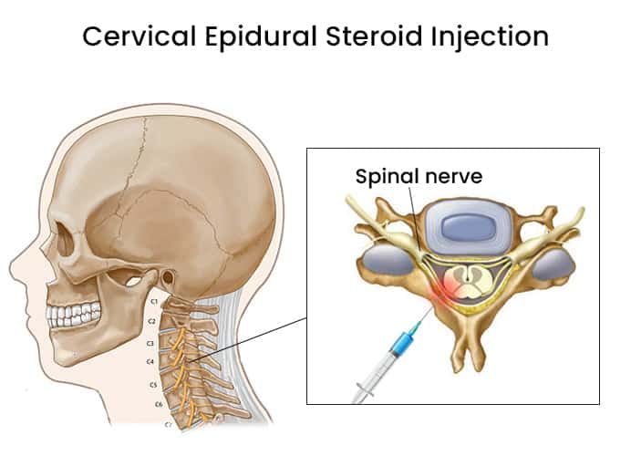 Cervical Epidural Steroid Injection NYC & NJ