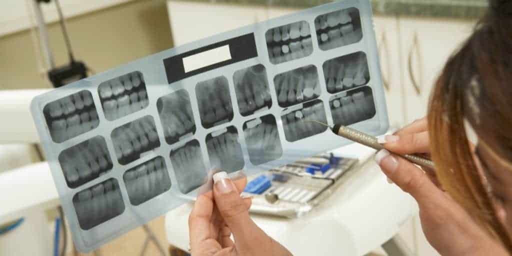 Dentist using dental scaler to point a section on dental X-ray result.