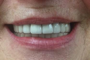 Smile gallery. Restored deteriorated teeth with a full set of upper and lower crowns.