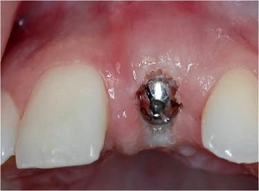 Smile gallery. Lost upper left central incisor due to breakage.