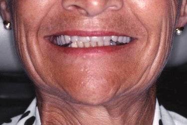 Smile gallery. Image of patient showing a loose fitting upper denture.