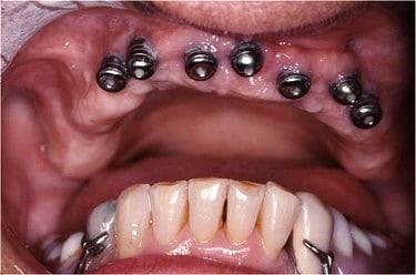 Smile gallery. Image of dental implant placement to the upper gums