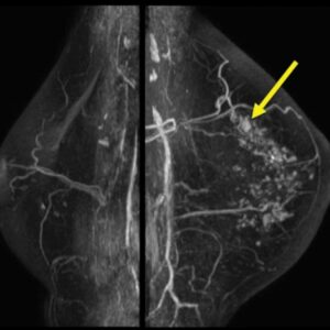 Breast cancer seen in an mri