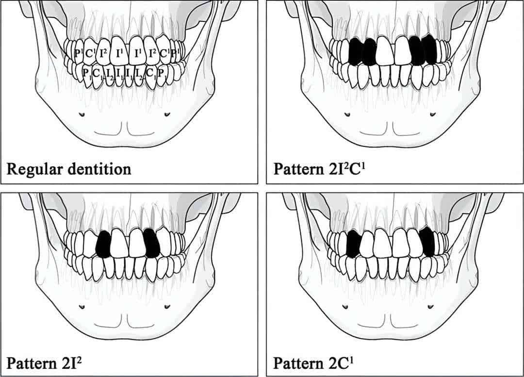 Diagram showing four jaws with tooth ablation removal